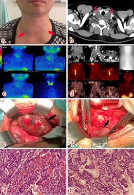 Spontaneous Remission After a Hypercalcemic Crisis Caused by an Intracystic Hemorrhage of Bilateral Parathyroid Adenomas: A Case Report and Literature Review